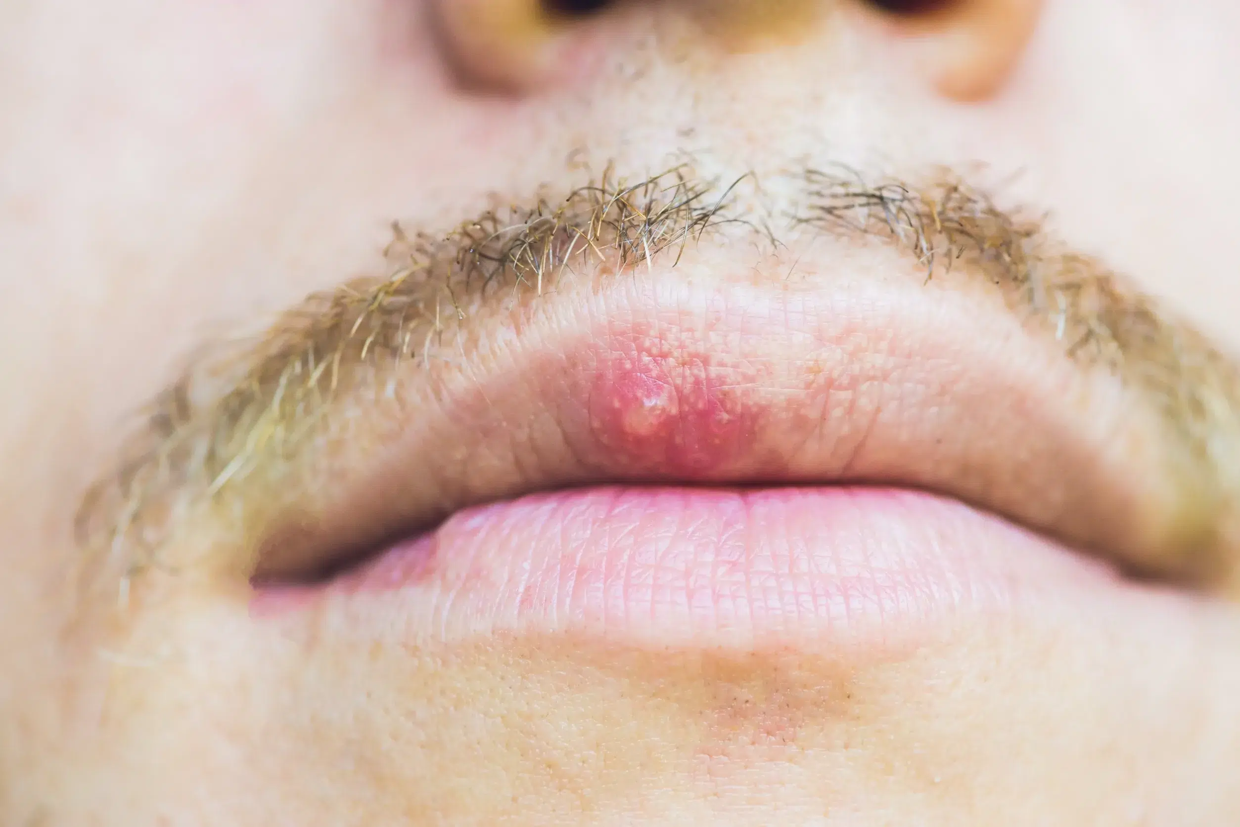 Bouton fièvre homme, Herpès labial