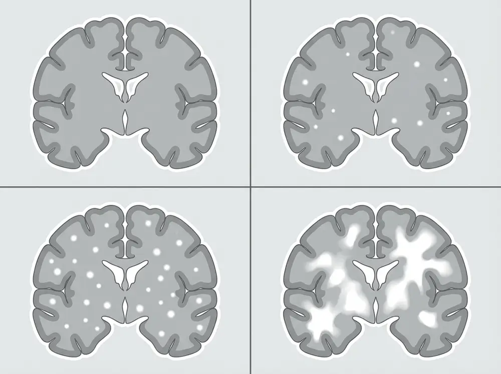 Illustration comparative des quatre stades de l'échelle de Fazekas pour évaluer la sévérité de la leucopathie vasculaire à l'IRM