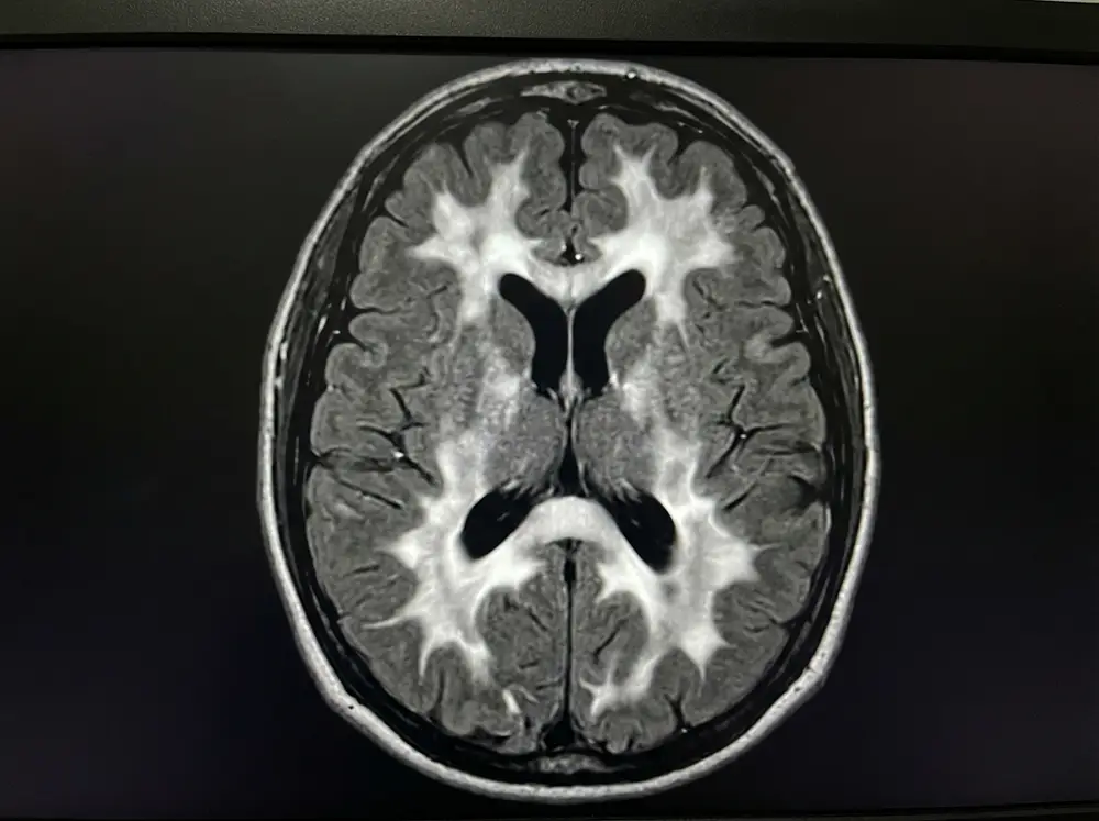 Coupe IRM axiale en séquence FLAIR montrant des hypersignaux périventriculaires de la substance blanche dans une leucopathie vasculaire