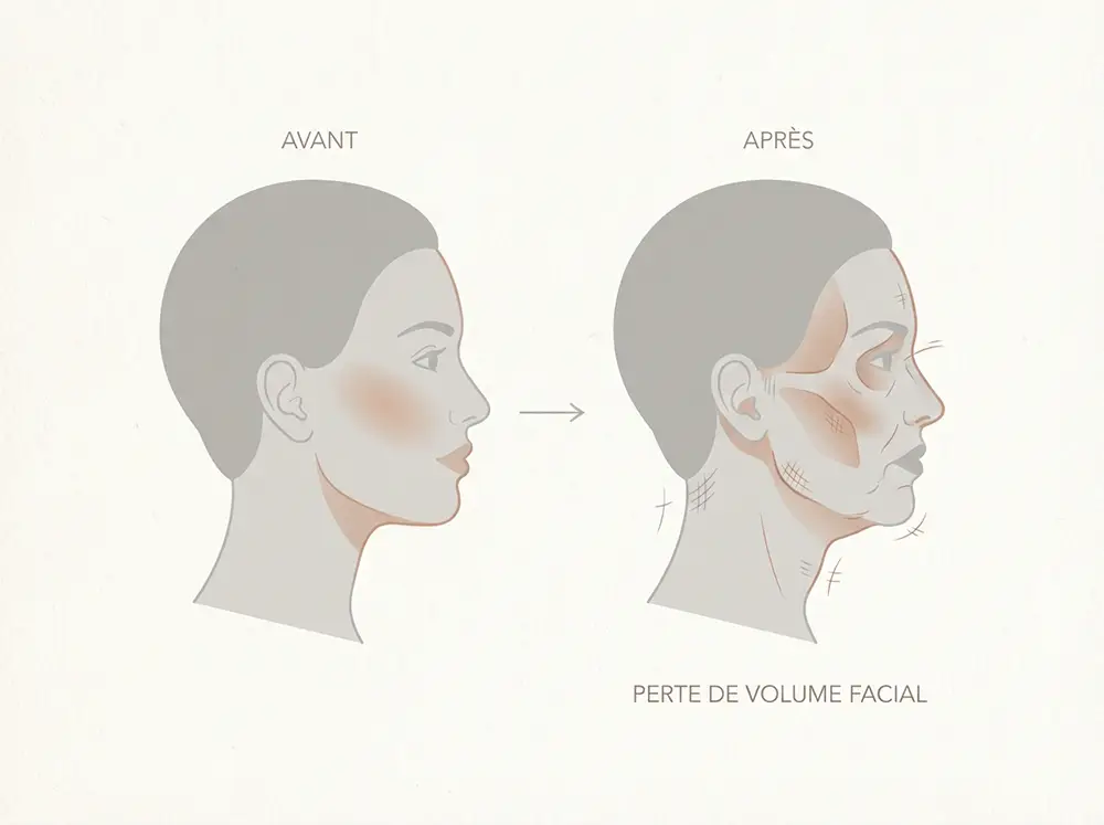 Illustration du visage Ozempic et perte de masse musculaire li&eacute;s au s&eacute;maglutide