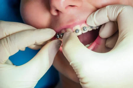 Praticien ganté ajustant l'arc métallique d'un appareil dentaire sur les dents d'un patient